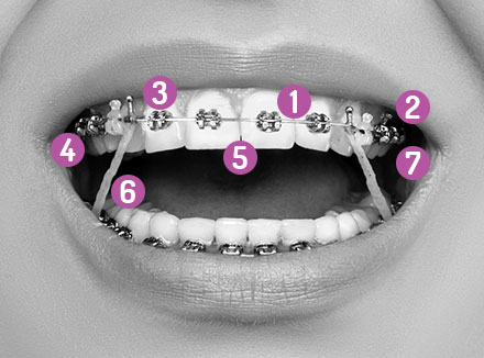 How Do Braces Work? - Ask an Orthodontist.com