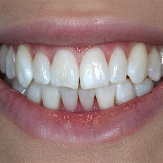 Boutique whitening case 01 after