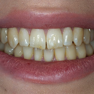 Boutique whitening case 02 before